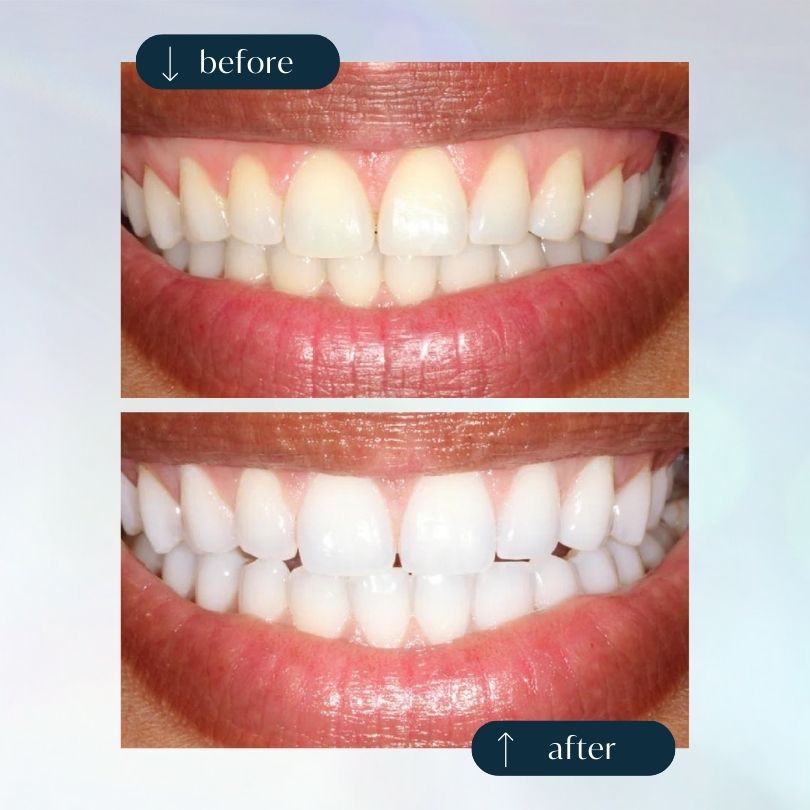 The Glow-Getter Whitening Kit